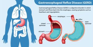What does science say regarding GERD